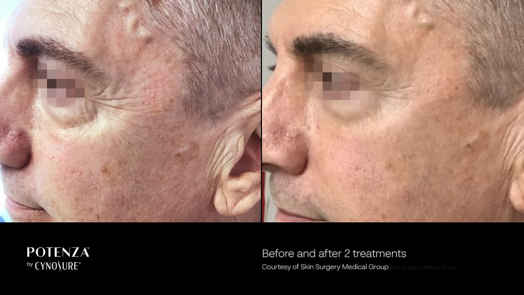 RF Microneedling Skin Rejuvenation Treatment Costa Mesa Newport