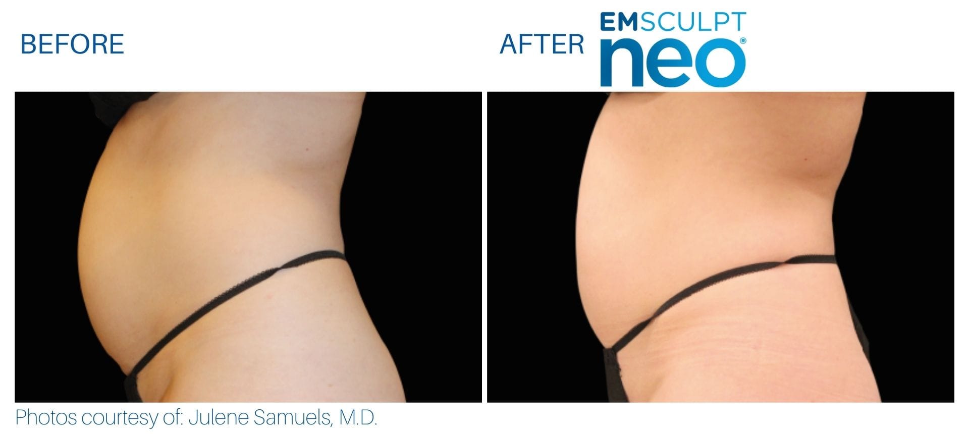 Emsculpt NEO Before and After