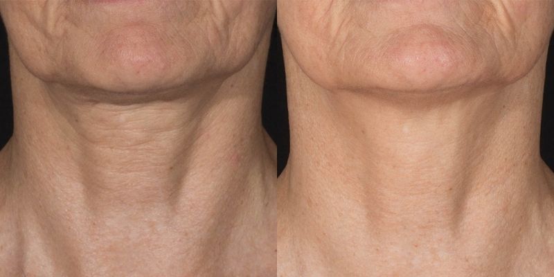 RF Microneedling Before and After